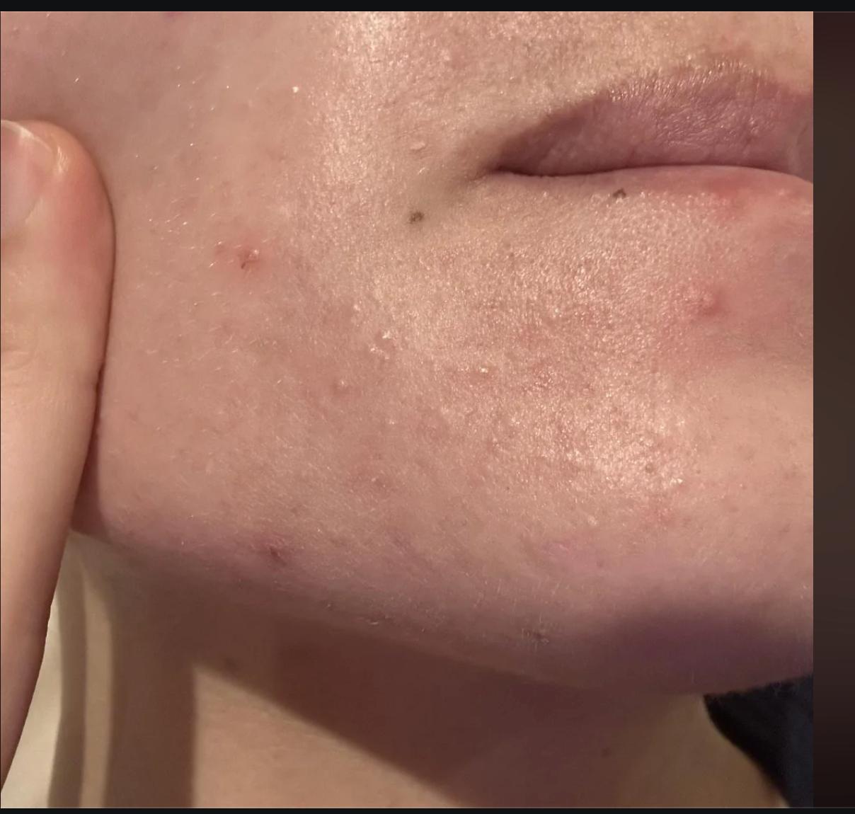 Bumpy acne-prone skin texture with whiteheads and congestion